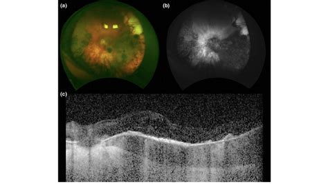 Bilateral Diffuse Uveal Melanocytic Proliferation B Dump A