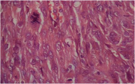 Spindle Cell Carcinomaof The Larynx A Case Report And Literature