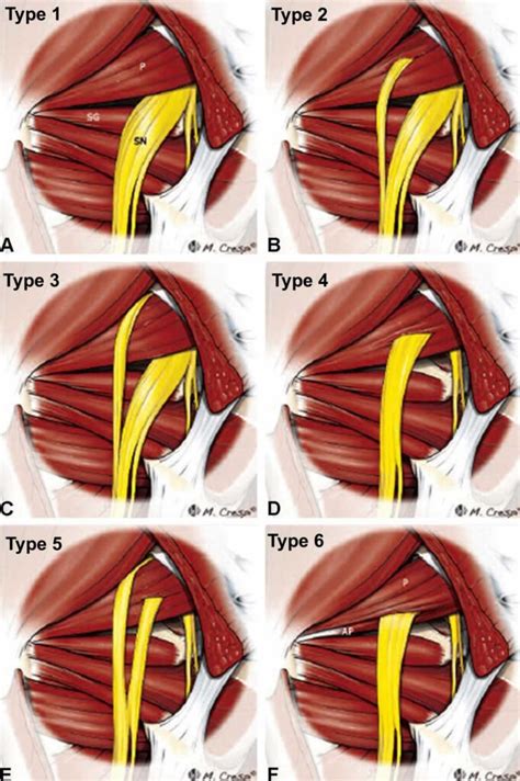 Sciatica Sciatica Pain Causes Diagnosis Treatment Exercises And Prognosis