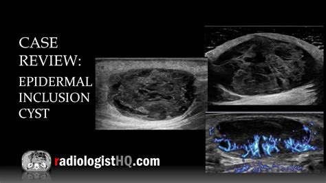 Epidermal Inclusion Cyst Vs Sebaceous Cyst Hot Sex Picture