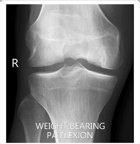 Intercondylar Fossa X Ray