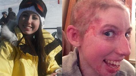 Burns Survivor Catrin Pugh Is Face Of Avon Beauty Campaign Bbc News