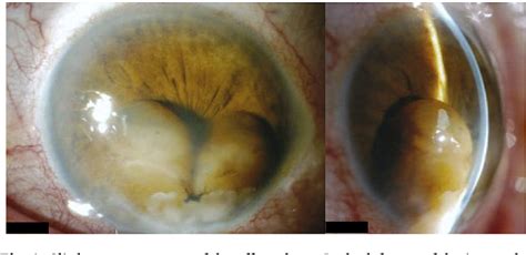 Figure 1 From A Case Of Morgagnian Cataract Mimicking An Iris Tumor