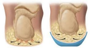 Treating Chronic Heel Pain At Compleet Feet Compleet Feet