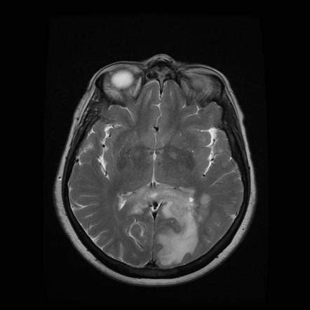 Lesions of the corpus callosum | Radiology Reference Article ...