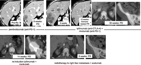 Rescue Therapy For Patients With Anti Pd 1 Refractory Merkel Cell Carcinoma A Multicenter