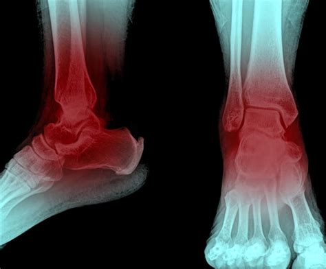 Film Ankle Xray Radiograph Showing Heel Bone Fracture After Fall From