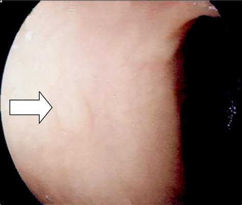 Figure 1 From A Solitary Colonic Neurofibroma In A Patient Without