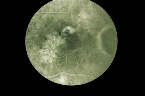 Presumed Ocular Histoplasmosis Syndrome Retina Image Bank