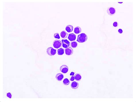 Cerebrospinal Fluid Csf Cytological Examination Showed Presence Of