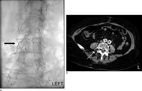 Re Double Coaxial Microcatheter Technique For Transarterial Aneurysm