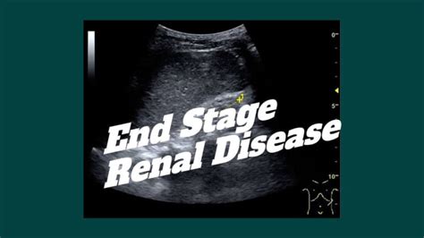 What Is End Stage Renal Disease Definition Causes Symptoms And Treatment