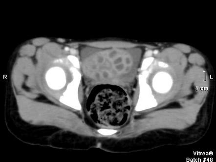 Ovarian Torsion Radiology Reference Article Radiopaedia Org