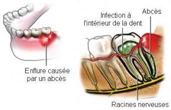 Abc S Dentaire Sympt Mes Complications Traitements Et Rem Des