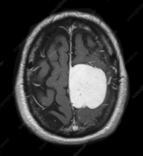 Parafalcine Meningioma MRI - Stock Image - C043/0277 - Science Photo Library