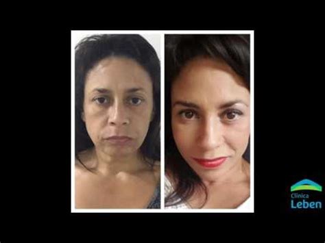 Impresionantes Cambios Faciales Realiza M Dico Franc S En Cl Nica Leben