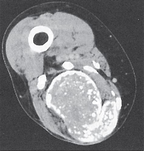 11 Soft Tissue Disease Radiology Key