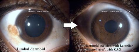 Limbal Dermoid – Cornea