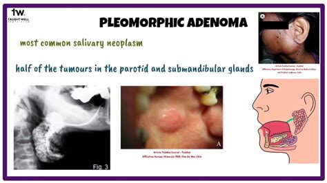 Pleomorphic Adenoma Oral Medicine Youtube