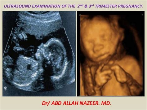 Presentation1.pptx, ultrasound examination of the 2nd & 3rd trimester…