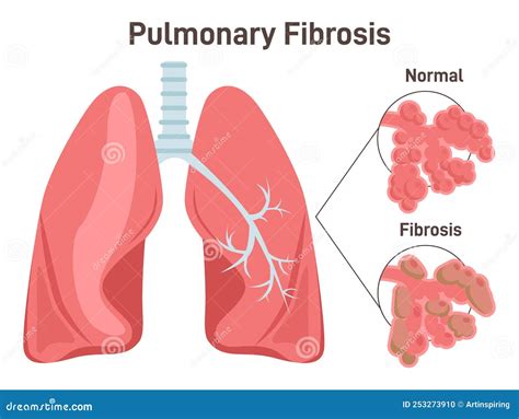 Pulmonary Fibrosis Lung Tissue Disease Stock Illustration