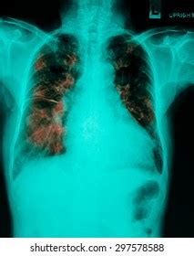 Xray Image Human Healthy Chest Mri