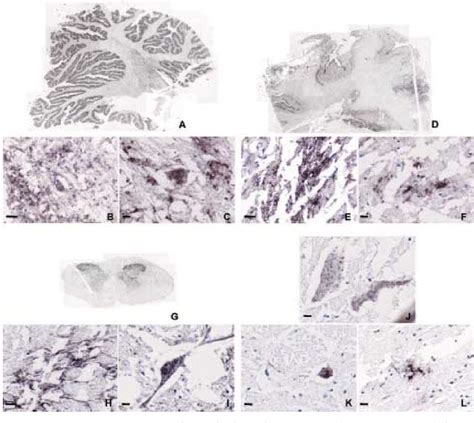 Figure 2 From Transmissible Spongiform Encephalopathy Diagnosis Using