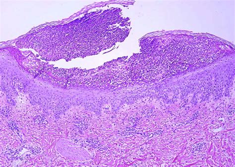 Acute Generalized Exanthematous Pustulosis Histology