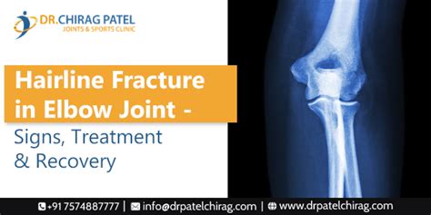 Hairline Fractures In Elbow Joint Treatment And Recovery