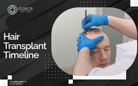 Hair Transplant Timeline Clinics United