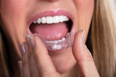 How Long Does Invisalign Take To Straighten Your Smile