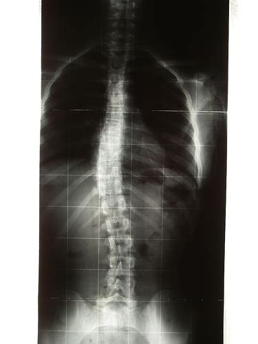 Scoliosis Creationwiki The Encyclopedia Of Creation Science