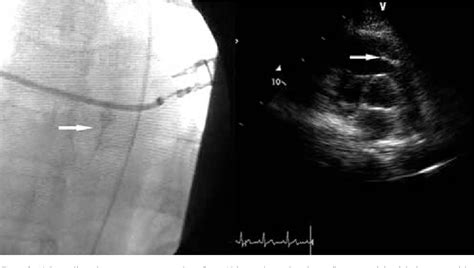 Figure From Onyx Distal Embolization In Transarterial Embolization Of