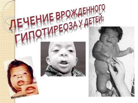 Врожденный гиподиреоз - online presentation