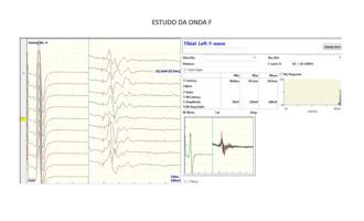 Eletroencefalograma Mapeamento Cerebral C Rtex Neurologia Diagn Stica