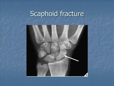 PPT Fractures And Dislocations Of The Wrist PowerPoint Presentation