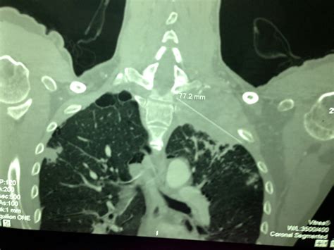 VIETNAMESE MEDIC ULTRASOUND: CASE 224: LEFT SUPRACLAVICULAR MASS, Dr ...