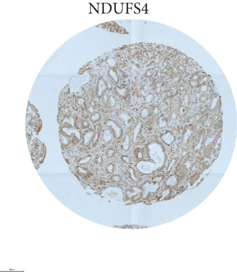 Staining Of Oxphos Complexes Vdac And Amacr P In A Prostate