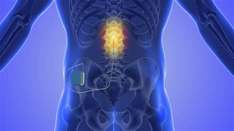 The Journey To Relief What To Expect During The Spinal Cord