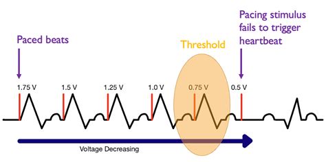 Pacemakers And Icds Emottawa Blog