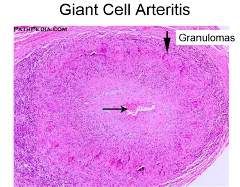 Rheum Diseases Pathology And Immunology Flashcards Quizlet