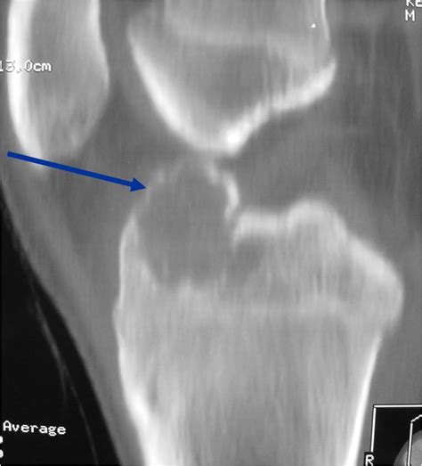 Chondroblastoma Bone Tumors Tumors Of The Bone