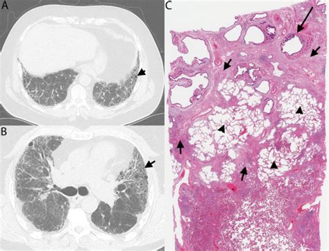 Interstitial Pneumonia