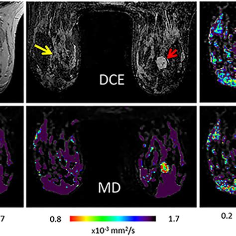 T2 Dce And Dti Parametric Maps Of Pabc Patient Representative Images