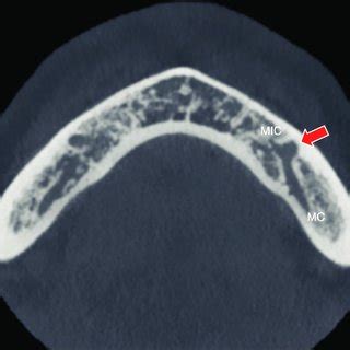 Continuity Of The Mandibular Incisive Canal Mic And Mandibular Canal