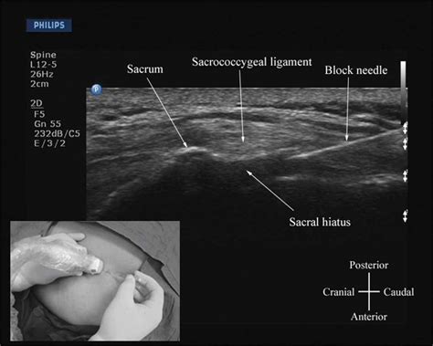 Lumbar Puncture Anatomy