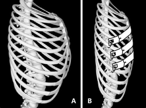 Minimally invasive surgical technique for barrel chest | Surgical Case Reports | Science ...