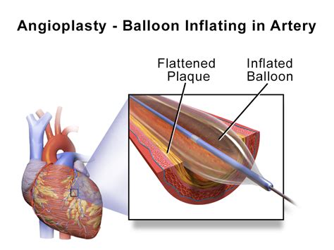 whats   treatment  coronary artery blockages medivizor