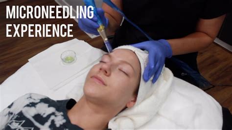 Microneedling Experience Vlog Youtube