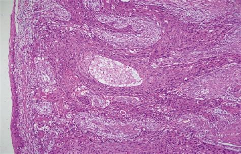 Squamous Cell Carcinoma Arising In A Sacrococcygeal Tailgut Cyst Anais Brasileiros De